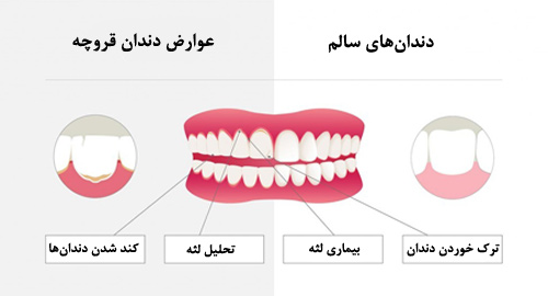 انواع درد دندان و علت آن %D8%AF%D9%86%D8%AF%D8%A7%D9%86%20%D9%82%D8%B1%D9%88%DA%86%D9%87 - انواع درد دندان و علت آن