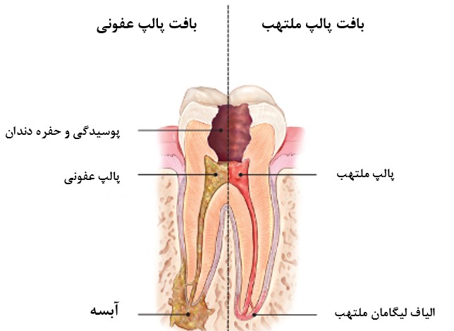 انواع درد دندان و علت آن ; - انواع درد دندان و علت آن
