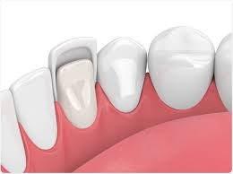 Dental Veneer.jpg Dental Veneer.jpg