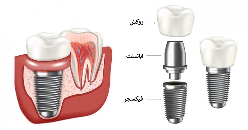 اجزای-ایمپلنت-2.jpg