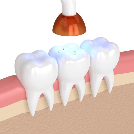 انواع ترمیم دندان.jpg