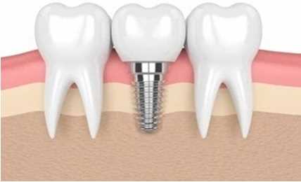 ایمپلنت-دندان-1.jpg