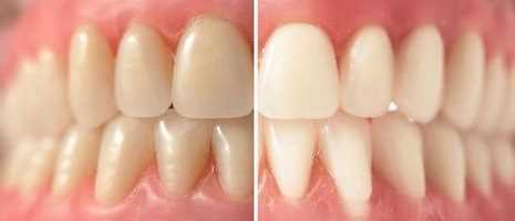 درمان بلیچینگ کلینیک دندانپزشکی دریای نور