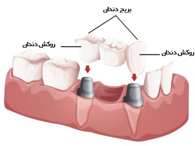 ترمیم دندان با روکش و بریج.jpg