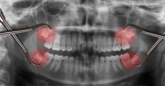 جراحی دندان های عقل.jpg