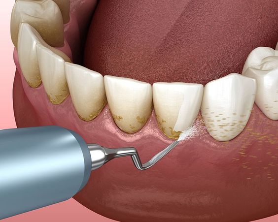 جرم گیری لثه برای حفظ سلامت دندان.jpg