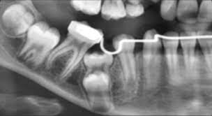 دندان فک جوش.jpg