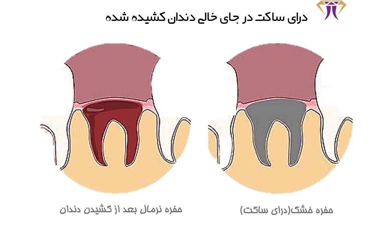 دندونم کشیدم جاش درد میکنه چیکار کنم.jpg