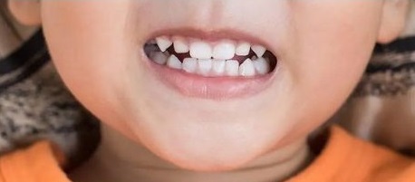 علت دندان قروچه کودکان .jpg