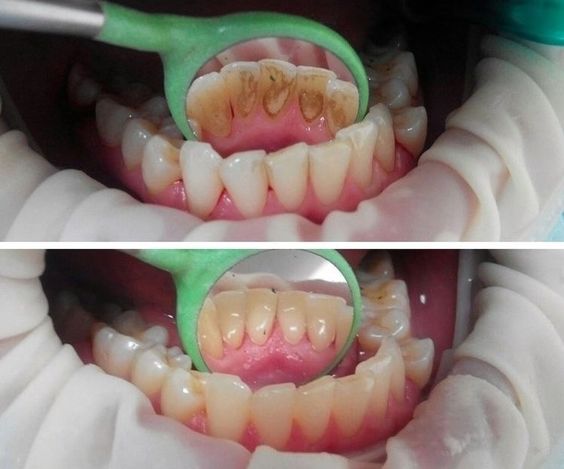 عکس قبل و بعد جرم گیری دندان.jpg