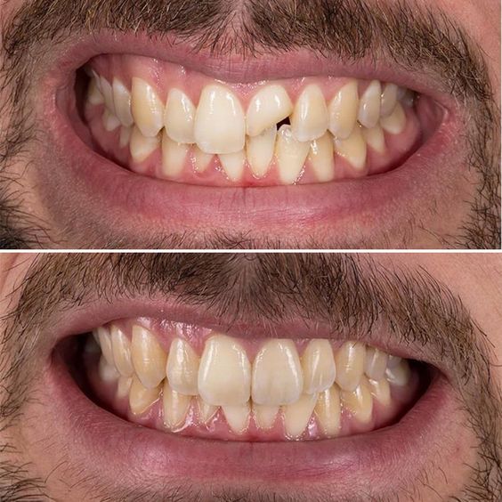 عکس قبل و بعد پروتز دندان.jpg