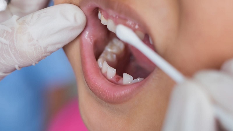 فلور تراپی دندان کودکان .jpg