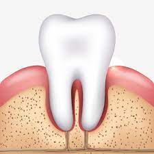 لق شدن دندان در اثر التهاب لثه.jpg