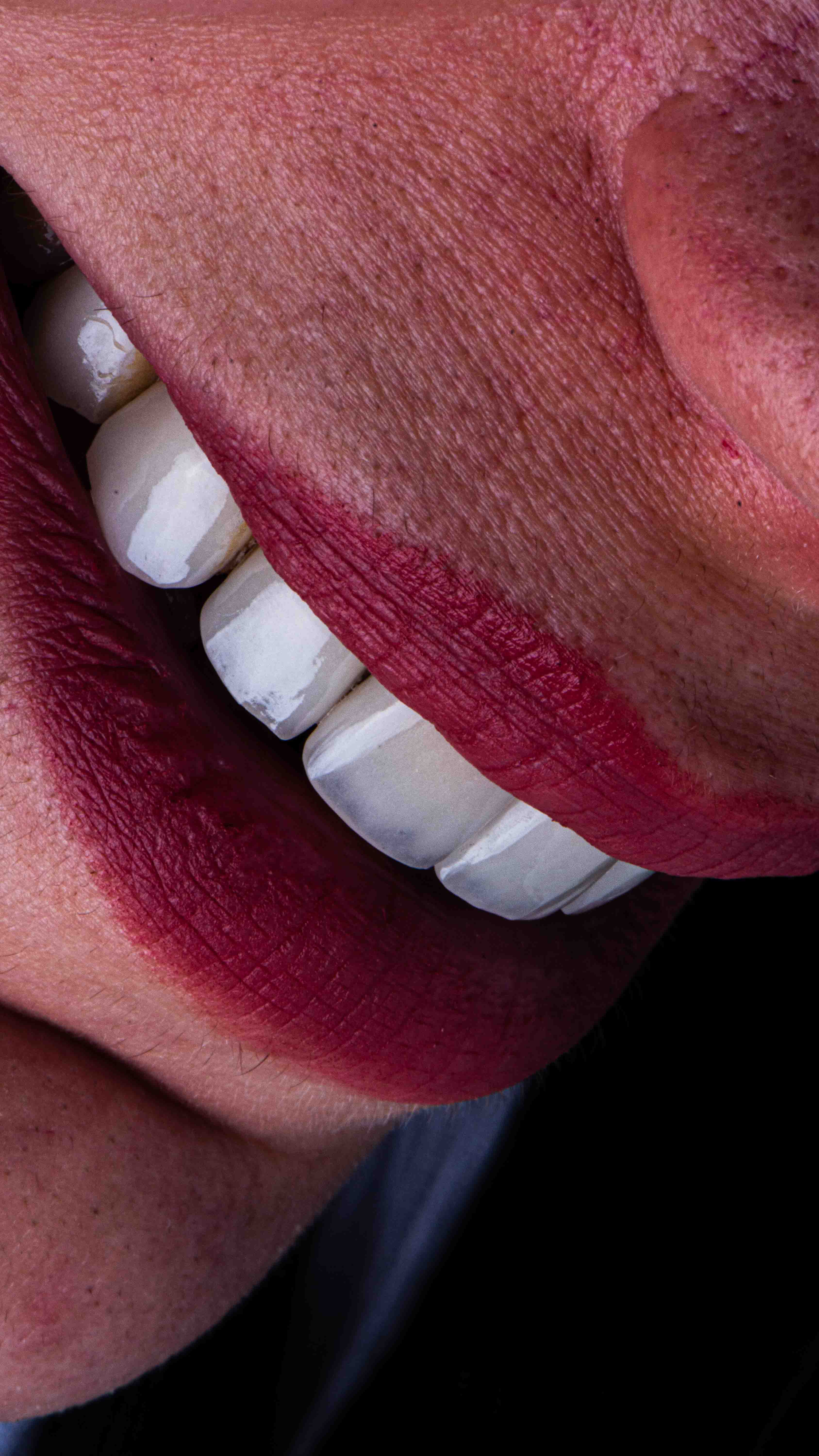 لمینیت دندان کلینیک دندان پزشکی دریای نور.jpg