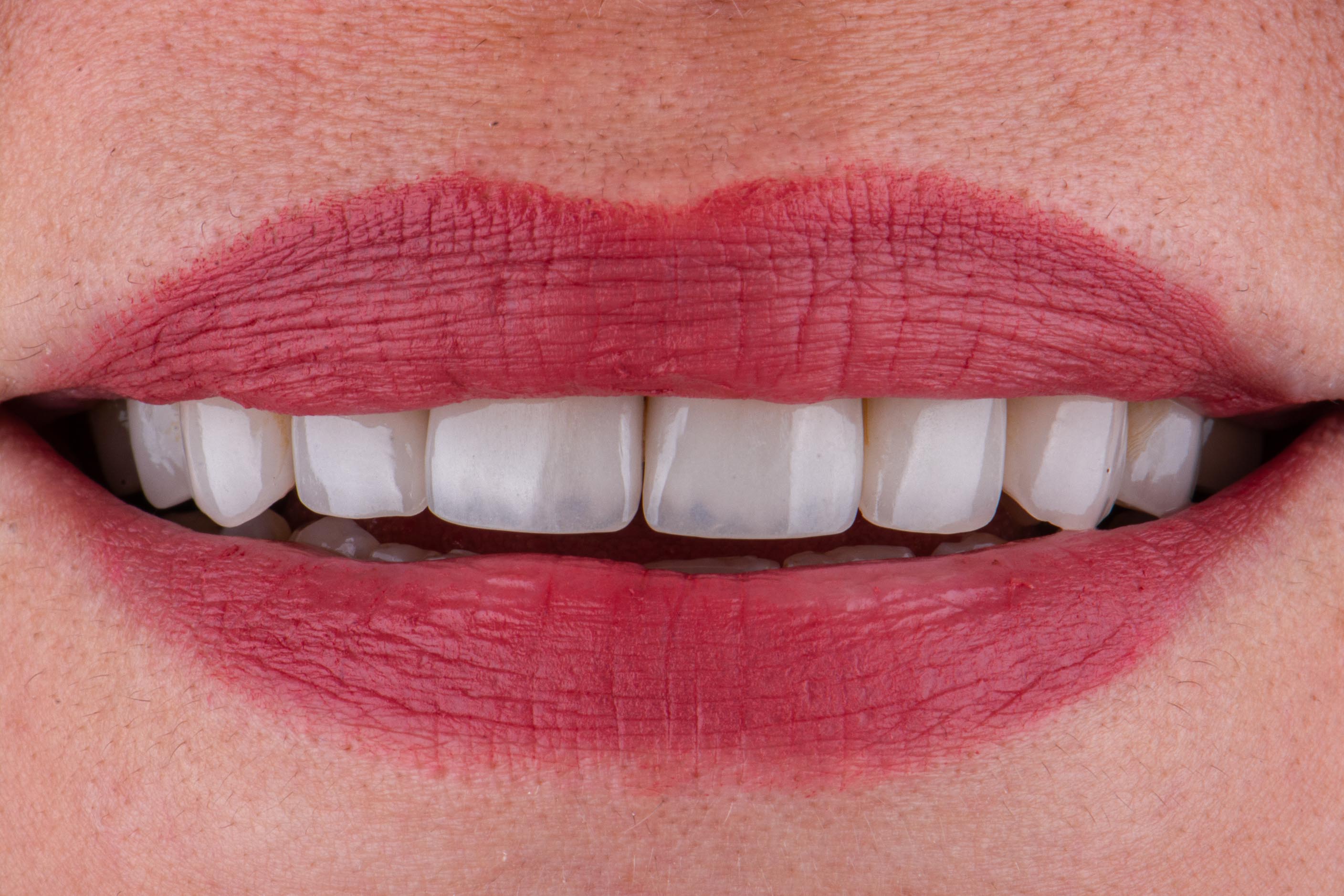 لمینیت دندان یکی از بهترین درمان های زیبایی.jpg