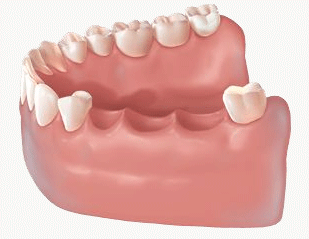 مراحل ساخت پروتز ثابت دندان.gif