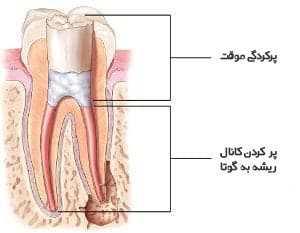 نحوه درمان ریشه دندان.png