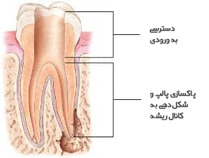 نحوه درمان ریشه.png