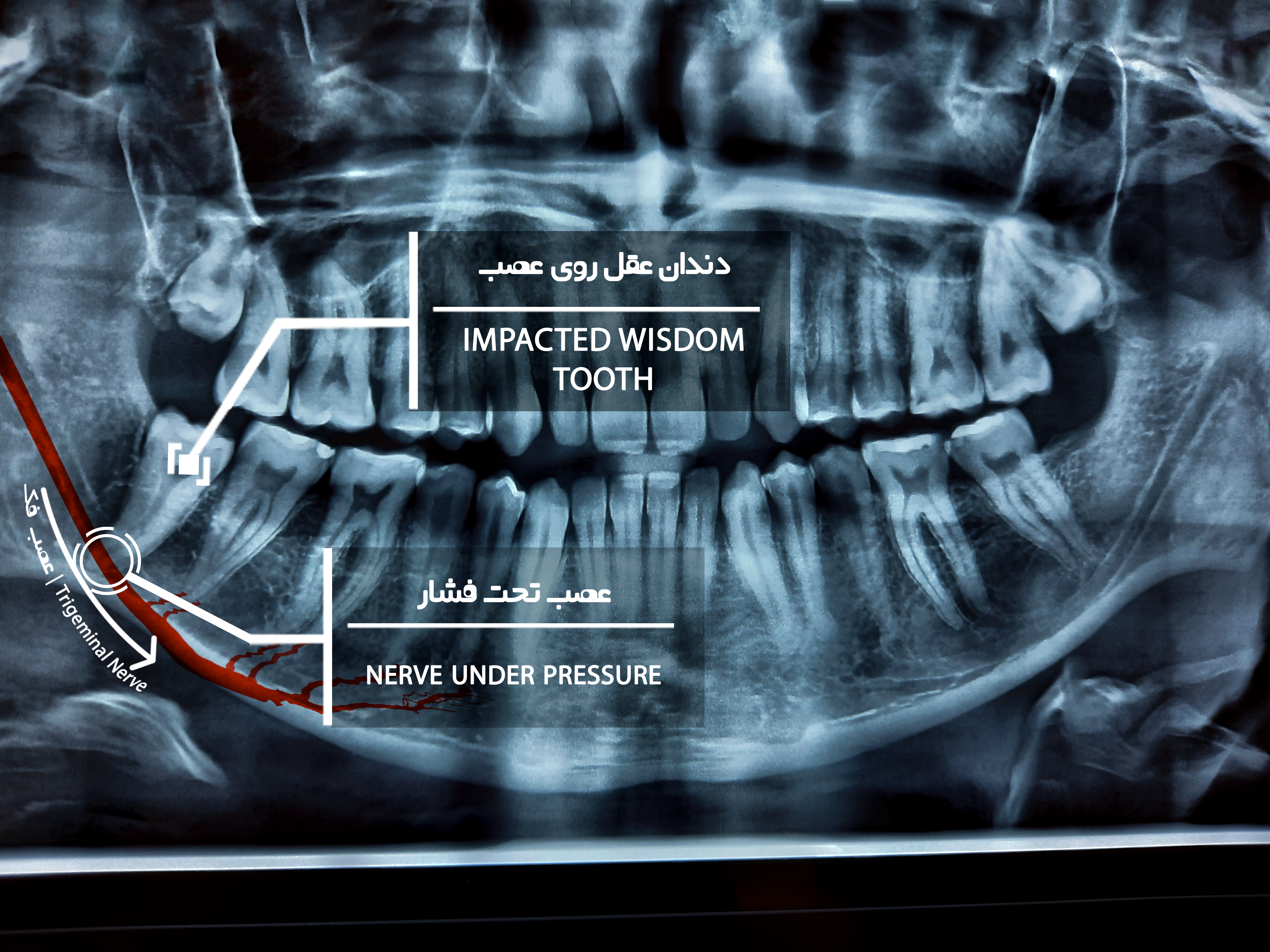 نزدیک به عصب-Recovered (1).png