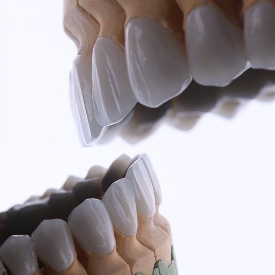 پروتز ثابت دندان چگونه است.jpg