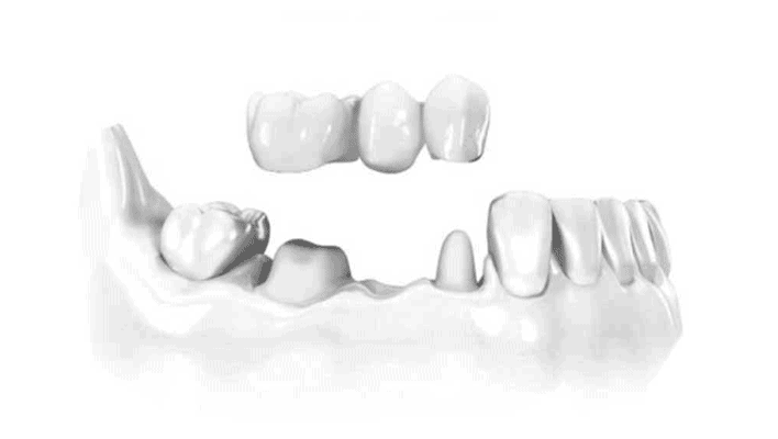پروتز ثابت دندان چیست.png
