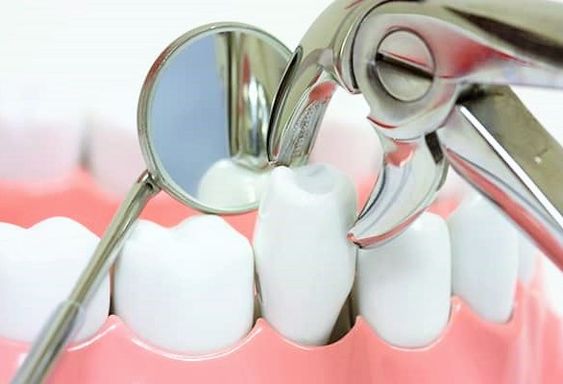 کشیدن دندان در دندانپزشکی.jpg