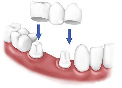 Dental bridges.jpg