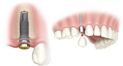Dental implant surgery.jpg