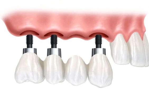 Dental implants.jpg