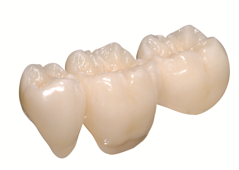 IPS dental veneers.png