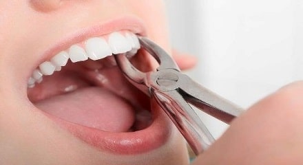 مراقبت های پس از کشیدن دندان