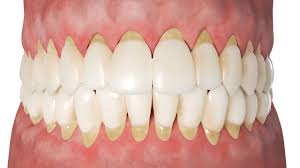 Periodontitis.jpg Periodontitis.jpg