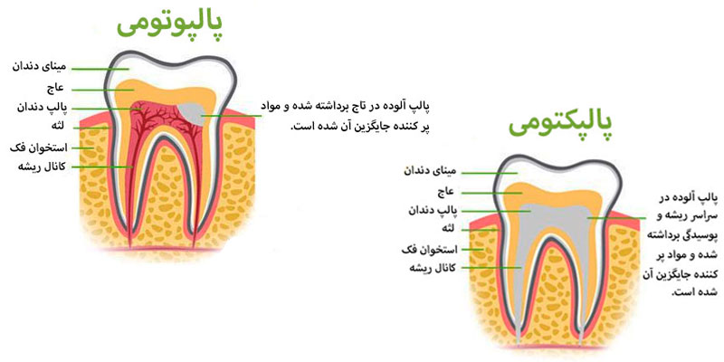 Pulpotomy-vs-Pulpectomy1.jpg