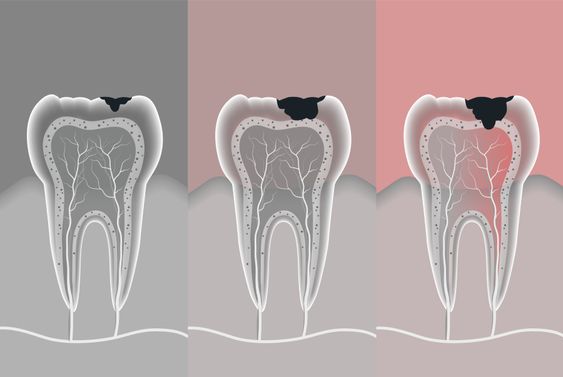 Repair of decayed teeth.jpg