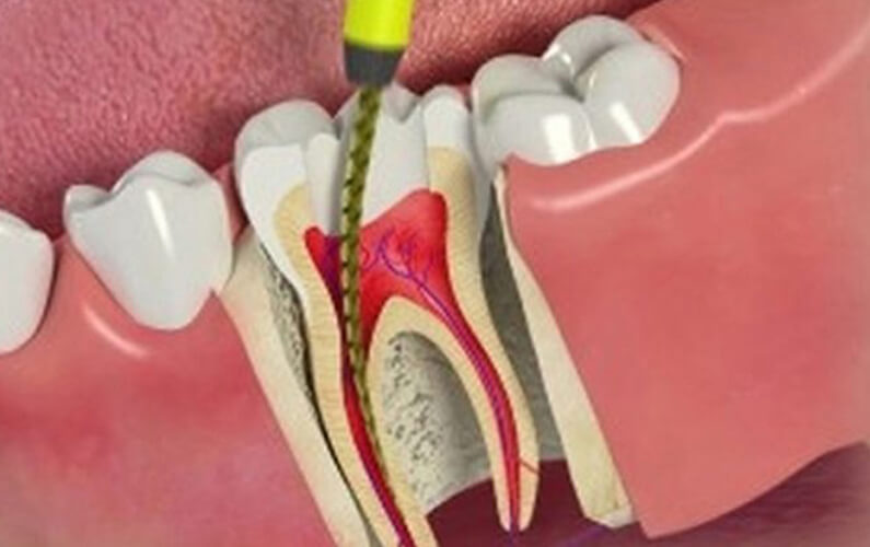 Root-Canal-Procedure.jpeg