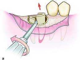 Steps of tooth extraction1.jpg