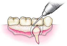 Steps of tooth extraction2.jpg
