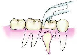 Steps of tooth extraction4.jpg