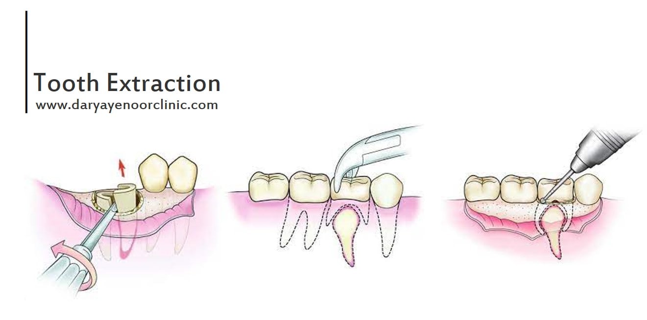 tooth extraction-min.jpg