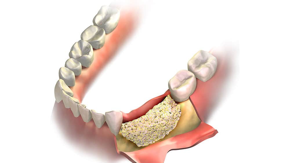 benefit-bone-graft.jpg