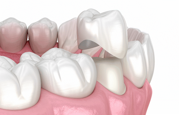 dental-crowns-2.gif