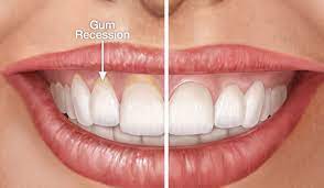 gum surgery1.jpg