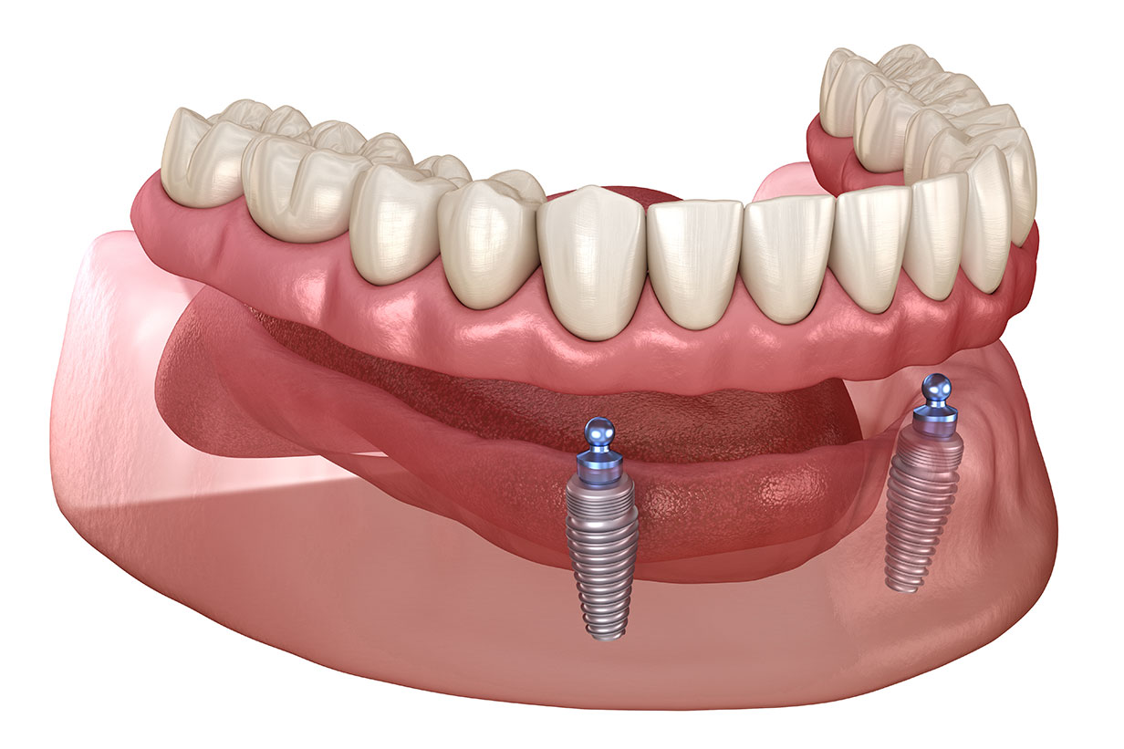 implant-supported-overdenture.jpg