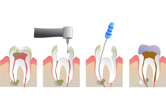 palpotomy.jpg