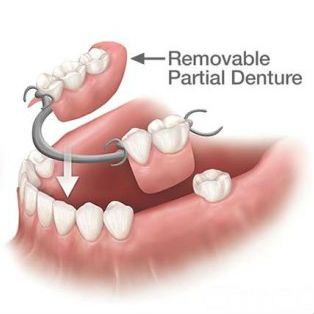 partial prosthesis.jpg