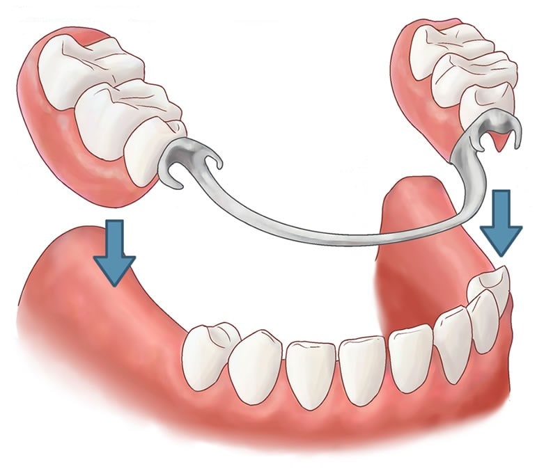 removable_partial_dentures_1.jpg