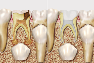root-canal-treatment.png