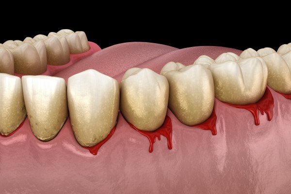 Gingivitis.jpg Gingivitis.jpg