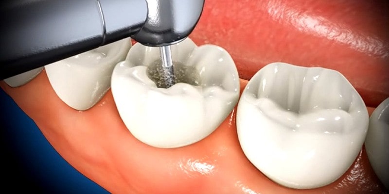 Root canal treatment during pregnancy.jpg Root canal treatment during pregnancy.jpg