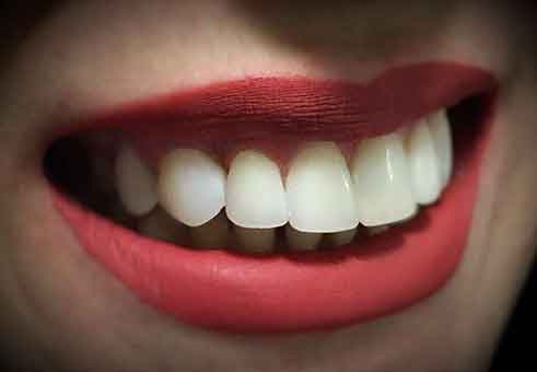 ترمیم زیبایی دندان با کامپوزیت ها (Composites)